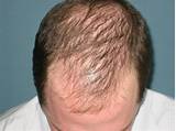 Hair Thinning Treatment Male Images
