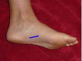 Images of Treatment For Plantar Fascial Fibromatosis