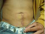Appendix Removal Recovery Time Pictures