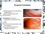 Conjunctival Pyogenic Granuloma Treatment Photos