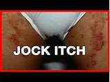 Jock Itch Doctor Photos