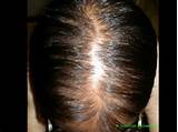 Pictures of Alopecia Doctor