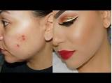 Covering Acne Scars With Makeup Photos