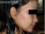 Images of Medication For Hives On Face