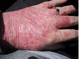 Photos of Hand Psoriasis Treatment