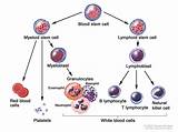 Pictures of T Cell Acute Lymphoblastic Leukemia Treatment