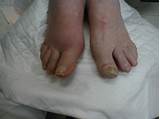 Great Toe Arthritis Treatment