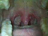 Images of Tonsillectomy Recovery Time