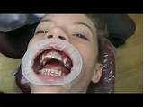How Do You Get Silver Teeth Pictures