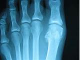 Tibial Sesamoid Fracture Treatment