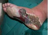 Severe Foot Fungus Treatment Pictures