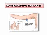The Implant Contraception Side Effects