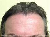 Widows Peak Hair Loss Treatment Images