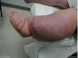 Pictures of Stage 3 Lymphedema Treatment