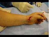 Pictures of Thumb Arthroplasty Recovery