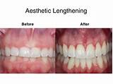 Pictures of Clinical Crown Lengthening
