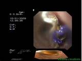 Images of Esophageal Varices Banding Recovery