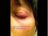 Chalazion Surgery Recovery Time Images