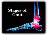 Marijuana And Gout Pictures