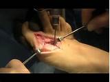 Foot Surgery For Bunions Recovery Photos