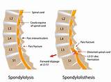 Pictures of Vacuum Phenomenon Lumbar Spine Treatment