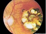 Photos of Parasite In Eye Treatment