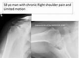Shoulder Reverse Arthroplasty Rehabilitation Images
