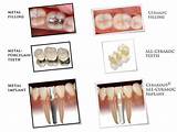 Materials Used In Dental Implants Images