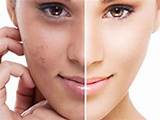 Dark Spot Face Removal Images