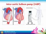 Intra Aortic Balloon Pump Pictures