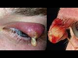 Upper Eyelid Infection Home Remedies Images