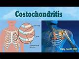 Costochondritis Home Remedies