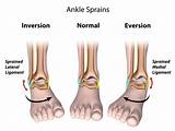 Photos of Inversion Ankle Sprain Treatment