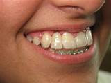 What Does A Partial Dental Plate Look Like Photos