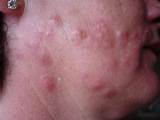 Images of Termites Skin Rash
