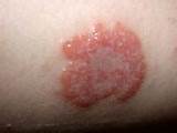 Weeping Eczema Treatment Pictures