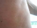 Hives Doctor Treatment Pictures