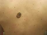 Images of Mole Removal Red Spot