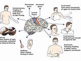 Pictures of Clinical Seizures Symptoms