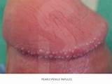 Penile Psoriasis Home Remedies Photos
