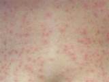 Pictures of Home Remedies For Chlorine Rash