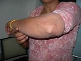 Photos of Dermatitis Herpetiformis Home Remedies
