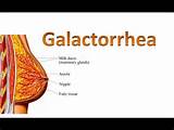Home Remedies For Galactorrhea Pictures