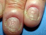 Infection Under Fingernail Home Remedies Images