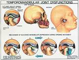 Pressure Sore On Ear Treatment Images