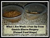 Images of What Can U Eat After Gastric Sleeve Surgery
