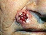 Rodent Ulcer Basal Cell Carcinoma Images