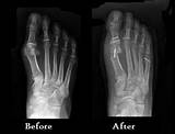 Images of Tailor''s Bunion Surgery Recovery
