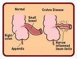 Photos of Side Effects Of Remicade For Crohn S