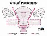 Recovery Time From Full Hysterectomy Pictures